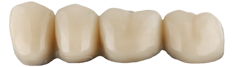 Dentadura postiza o implantes dentales. ¿Qué es mejor?