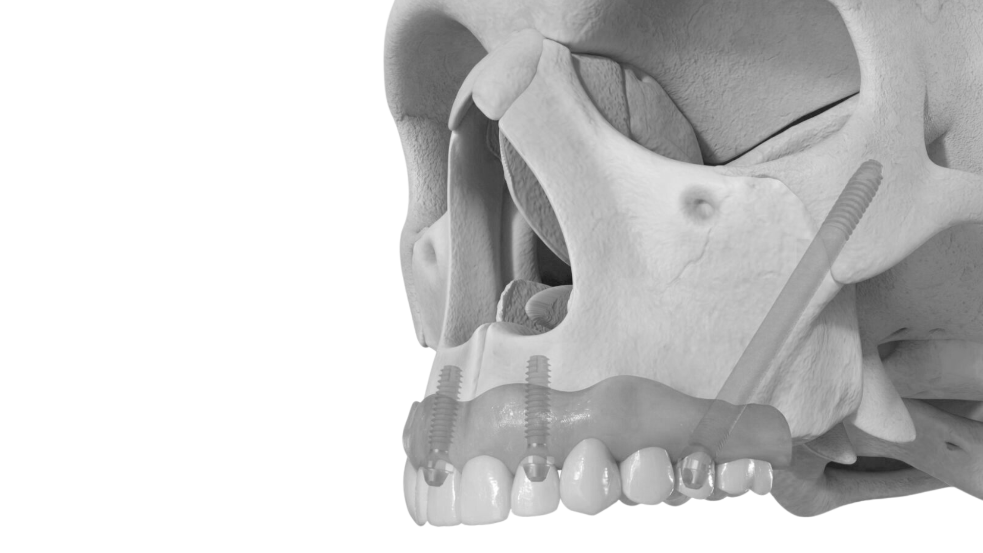 Qué beneficios aportan los implantes zigomáticos a pacientes con poco hueso