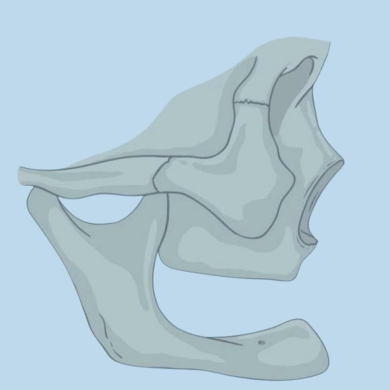 implantes zigomáticos